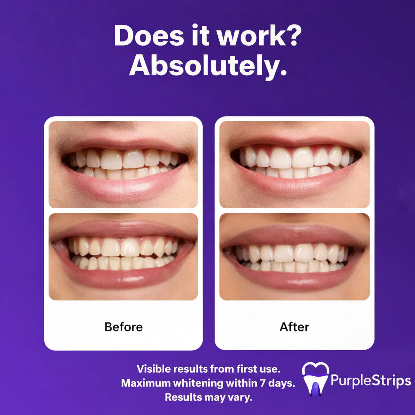 Purple Whitening Strips™